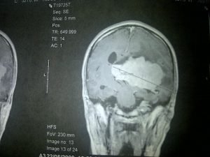 Scan of A Intraventricular Meningioma