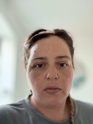 Recovery brought neurological changes, fatigue and word-finding difficulties — but Sophie continued to speak openly about the reality of life after brain surgery.