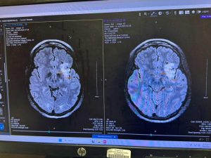 Jaime Olbertz Brain Tumour Scan