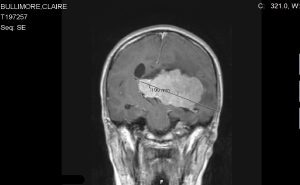 Claire Bullimore Brain Tumour Support Advocate, MRI Scan